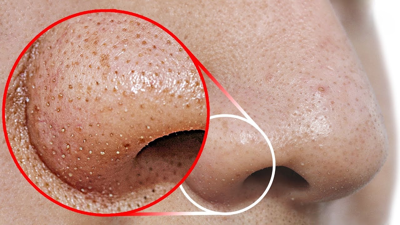 Pimple Popping Secrets